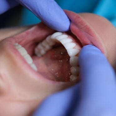 Zirkon diş  nədir? Üstünlükləri və fərqləri